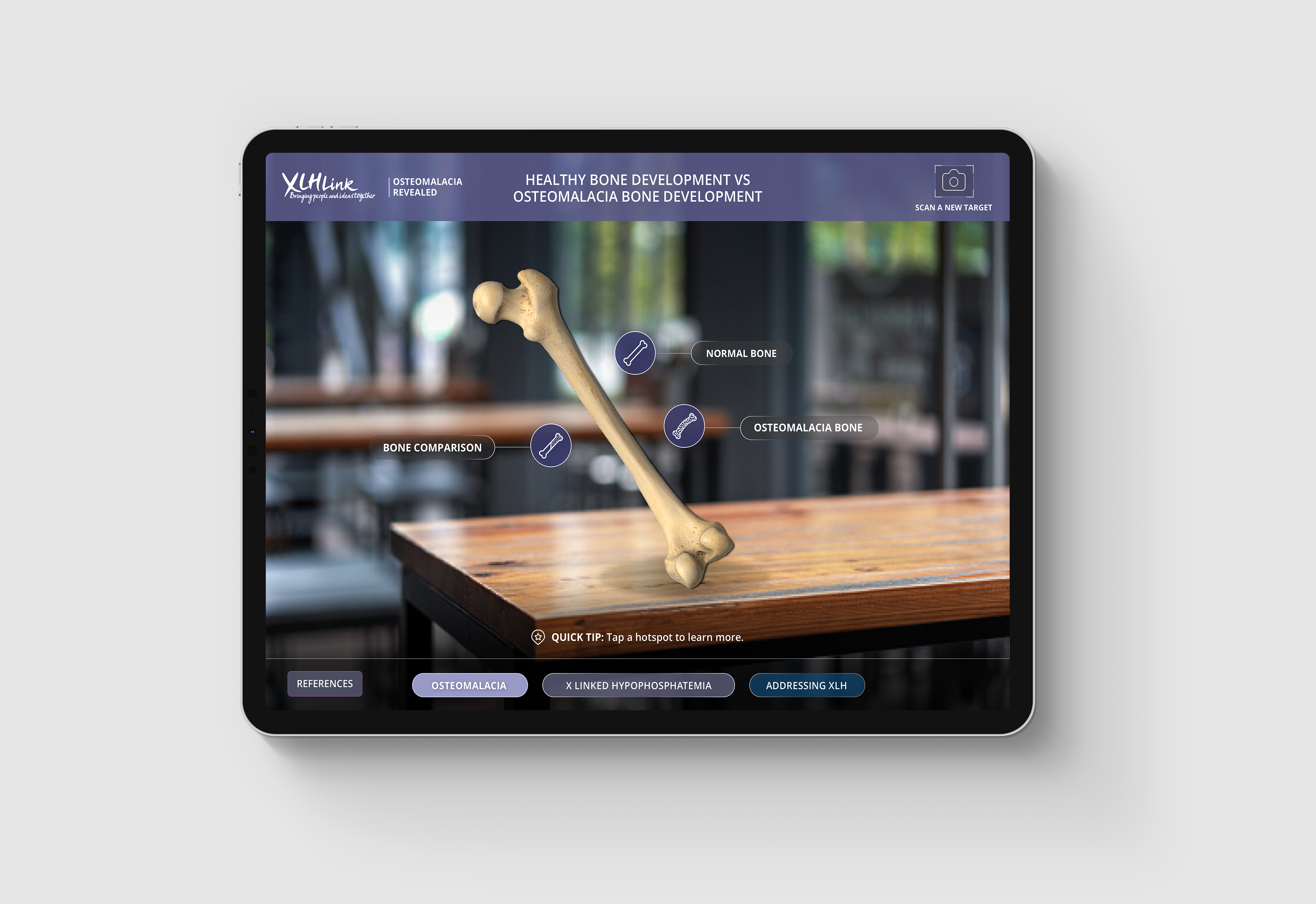 an iPad screen with a femur bone with 3 labels for normal bone, osteomalacia bone and bone comparison